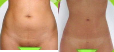 25-34 year old woman treated with Liposculpture - 25-34 year old woman treated with Liposculpture