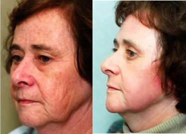 Facelift and Fraxel Laser treatment - This patient had a deep plane facelift/necklift, eyelid surgery and three Fraxel treatments to improve the tone and texture of her skin.&nbsp;