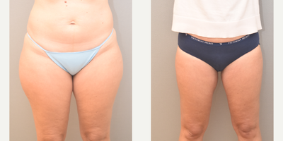 45-54 year old woman treated with SAFELipo - 47 with liposuction of inner and outer thighs, and banana rolls performed under local anesthesia with sedation in our on site certified operating suite.