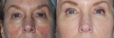 Excel V, Micro-Needling and Medical Grade Skincare - What great things a combo of skincare treatments can do. Non-surgical beautification is a process but with patience and commitment, transformation happens!