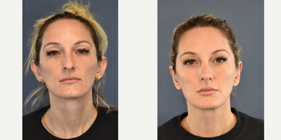 Woman treated with Ear Surgery - Woman treated with Ear Surgery.
