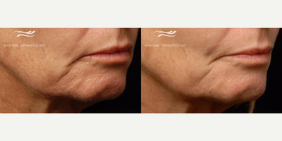 55-64 year old woman treated with Infini RF - Wrinkles around mouth and chin are less visible.