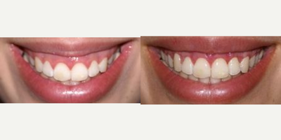 25-34 year old woman treated with Lip Lowering - This patient's gummy smile was treated with upper lip lowering so the upper lip appears to be more full.