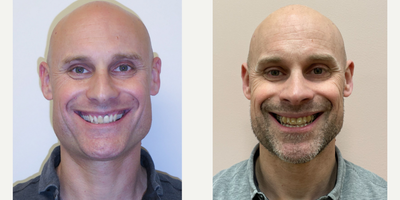 45-54 year old man treated with Jaw Surgery - Double Jaw Surgery followed by Invisalign