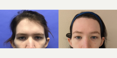 Patient treated with Forehead Reduction, Brow Lift - Forehead Lift, Hairline Lowering, Supra Orbital Bone Reduction and Contour - 25 to 34 year-old female patient is 1 year post-op from Facial Feminization surgery. Her procedures included: Forehead Lift, Hairline Lowering, Supra Orbital Bone Reduction and Contour, Septorhinoplasty (closed) with Cartilage Grafts and Weirs, Chin Reduction and Contour, Soft Tissue to Nasolabial Folds, and Thyroid Cartilage Shave.