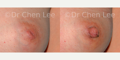 35-44 year old woman treated with Nipple Surgery - This 35-year-old woman had an inverted left nipple surgery performed by Dr Chen Lee in Montreal. She was able to manually externalize the inverted left nipple inverted. Surgery was performed only on the affected left nipple:- 30-minute procedure- outpatient surgery- local anesthesia- unilateral grade 2 nipple inversion- interferes with future ability to breastfeed on the left breastThe photographic follow-up was obtained 7 days after surgery.Note that surgical cases of Dr. Chen Lee are presented for illustrative and educational purposes only. These illustrative cases should not be construed as a guarantee nor assurance as to the surgical results attainable by prospective patients.*********************************************************************************************************************************************Cette femme de 35 ans avait un seul mamelon invers, le gauche perform par Dr Chen Lee  Montral. Elle peut manuellement faire ressortir le mamelon gauche invagins. La chirurgie a t effectue uniquement sur le mamelon gauche:- Procdure de 30 minutes- Chirurgie ambulatoire (d'un jour)- Anesthsie locale- Inversion unilatrale du mamelon de grade 2- Allaitement du sein gauche impossibleSuivi photographique a t obtenue  7 jours aprs la chirurgie.Notez que les cas de chirurgie du Dr. Chen Lee sont prsents  titre indicatif et ducatives seulement. Ces cas illustration ne doit pas tre interprt comme une garantie ni comme une assurance quant aux rsultats chirurgicaux ralisables par les patients potentiels.Case #002