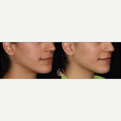 Woman treated with eMatrix - Woman treated with eMatrix