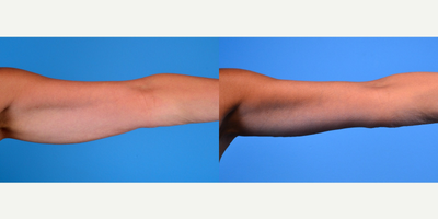 55-64 year old woman treated with Arm Lift - 59 year old female treated with an arm lift (brachioplasty)