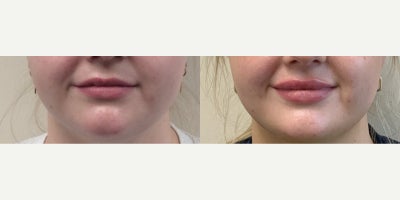 25-34 year old woman treated with Lip Fillers, Restylane - Kysse Lip filler