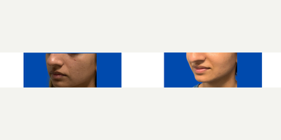 18-24 year old woman treated with Microneedling, SkinPen - 18-24 year old woman treated with Microneedling, SkinPen3 sessions