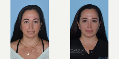 Woman treated with Buccal Fat Removal - Woman treated with Eyelid Surgery through upper blepharoplasty, Rhinoplasty, Buccal Fat Removal, ThermiTight, and Chin Liposuction to create definition and improve the cervicomental angle.Patient is shown before and 9 months post-op.