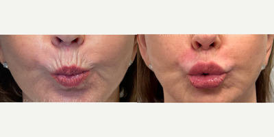 55-64 year old woman treated with Volbella, Vollure, Juvederm, Restylane, Restylane Refyne, Voluma, Restylane Lyft, Restylane De - A woman in her 60s, after 2 sessions of lip and perioral line filler.