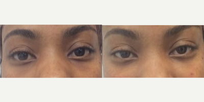 18-24 year old woman treated with Restylane - We injected this woman's under eyes with Restylane to help with the dark circle under her eyes. We used one syringe.