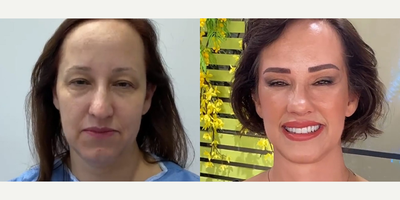51 year old woman treated with Cheek Augmentation - 51 year old woman treated with Cheek Augmentation through facial fat transfer as well as Deep Plane Facelift,Eyelid Surgery,Rhinoplasty, andNeck Lift,shown 1 year post op. Patient felt disturbed by the shape of her nose and her droopy face.