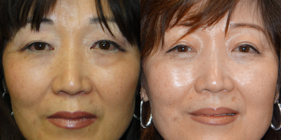 65-74 year old woman treated with Double Eyelid Surgery - Treated with Bilateral Double Eyelid Surgery.