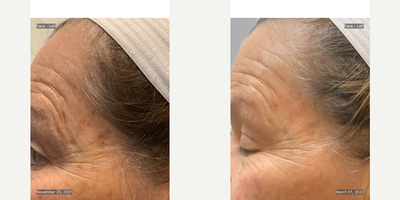 55-64 year old woman treated with Microneedling, Skin Rejuvenation, Vampire Facelift, Vampire Facial, Skin Tightening - 55 year old female with severe sun damage and deep wrinkling. 3 Microneedling with prp sessions were done 1 month apart.
