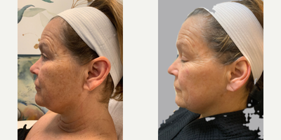55-64 year old woman treated with Microneedling, Skin Rejuvenation, Vampire Facelift, Vampire Facial, Skin Tightening - 55 year old female with severe sun damage and deep wrinkling. 3 Microneedling with prp sessions were done 1 month apart.