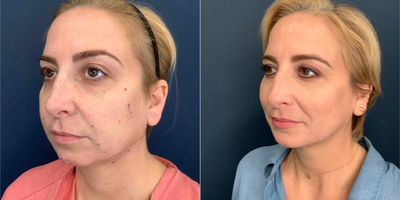 35-44 year old woman treated with Silhouette InstaLift - This 43 year old patient had a silhouette instalift to achieve more definition in her jawline and cheeks. She experienced little downtime and loves her result.