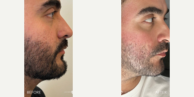 25-34 year old man treated with Fraxel Laser, CO2 Laser, Punch Excision - CO2 & Fraxel lasers remove skin layers to promote new growth, while punch excision physically removes scar tissue. The best option depends on scar type.