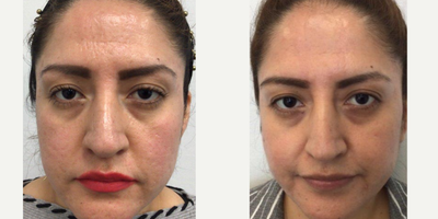 25-34 year old woman treated with Microneedling RF - 33 year old woman treated with Genius Microneedling with RF to reduce acne scars. Pictures show improvement 1 month after 2nd treatment of Microneedling with RF for acne scars