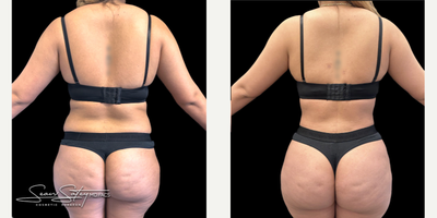 26 year old female treated with VASER Liposuction, Renuvion J Plasma Skin Tightening and post-operative lymphatic massages - 26 year old female who underwent VASER assisted liposculpting and Renuvion J plasma skin tightening of the abdomen, flanks, axilla, upper/middle/lower back; fat grafting to the buttocks and lateral hips (Brazilian Buttock Lift, BBL). Patient underwent 6 post-operative lymphatic massages.