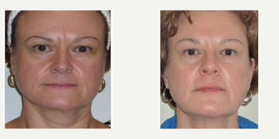 55-64 year old woman treated with Radiesse - ReFirme Skin Rejuvenation performed on patient.