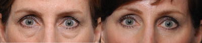 45-54 year old woman treated with Eyelid Surgery - Upper and lower blepharoplasty. Notice the lower bags removed and the smooth, scar free lower lids. The upper lids are lifted with a fuller, youthful roll.