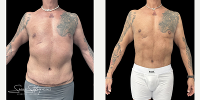 55-64 year old man treated with Abdominal Etching, Liposuction, Lymphatic Massage, Renuvion, Scar Removal, Skin Tightening, Vase - 55 year old gentleman who underwent VASER assisted liposculpting and Renuvion J plasma skin tightening of the abdomen, flanks, chest, axilla, lower back; chest masculinization procedure with fat grafting to the chest.