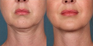 Kybella - Photo provided courtesy of Kythera, Inc.