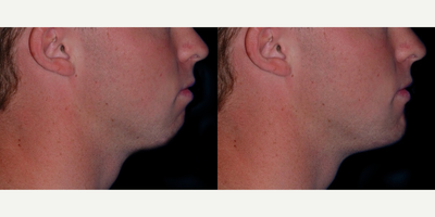 18-24 year old man treated with Chin Implant - Male Chin Implant