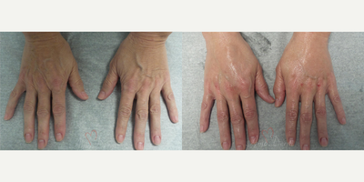 45-54 year old woman treated with Hand Rejuvenation, Radiesse, Juvederm - Hand rejuvenation with dermal filler injection (Radiesse, Juvederm) using micro-cannula technique