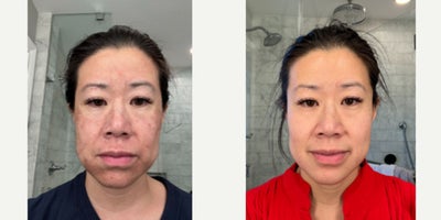 Chemical Peel for Discoloration and Dark Spots - 45 year old female treated with chemical peel for her concerns of discoloration, hyperpigmentation, age spots, dark spots, and fine lines