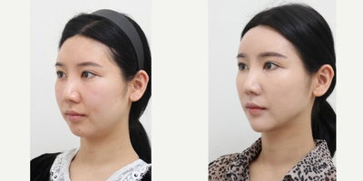 25-34 year old woman treated with Liposuction, Laser Liposuction, Nonsurgical Facelift, AccuLift - 28 Years old female patient Chief Complain: Bulky cheeks, face always looks swelled, face assymetry ( Right side bigger than Letf one), small chine and flat forehead. Treatment Plan: face liposuction (double chin, cheek bone, cheeks)non surgical facelift by fat graft : forehead, nasolabial folds, chinOutcome: face shape balance, reduce exessive fat, more V-lined shape