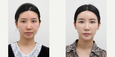 25-34 year old woman treated with Liposuction, Laser Liposuction, Nonsurgical Facelift, AccuLift - 28 Years old female patient Chief Complain: Bulky cheeks, face always looks swelled, face assymetry ( Right side bigger than Letf one), small chine and flat forehead. Treatment Plan: face liposuction (double chin, cheek bone, cheeks)non surgical facelift by fat graft : forehead, nasolabial folds, chinOutcome: face shape balance, reduce exessive fat, more V-lined shape