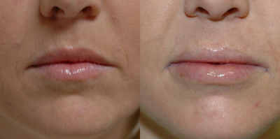 18-24 year old woman treated with Lip Implants - This 24 year old patient came in saying she wanted fuller lips. After a few consultations with Dr. Kass, she elected to have the procedure done.&nbsp;