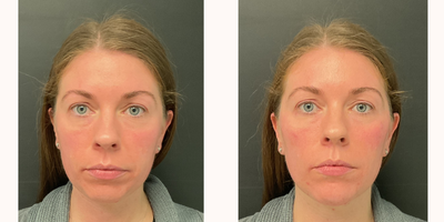 25-34 year old woman treated with Juvederm, Voluma, Volbella, Vollure, Dermal Fillers, Chin Filler - Facial Balancing treatment: cheeks, chin, undereyes