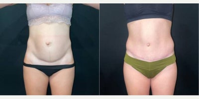 25-34 year old woman treated with Tummy Tuck, Umbilical Hernia Repair - This is a 33-year-old female who has concerns about her overhanging pannus and umbilical hernia. The procedure performed was an abdominoplasty with umbilical hernia repair. The photos show 9 months post-op.