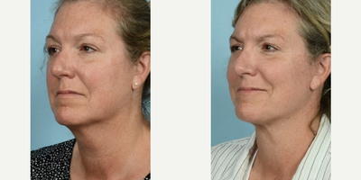 Woman treated with Rhinoplasty, Eyelid Surgery - Woman treated with Rhinoplasty, Eyelid Surgery