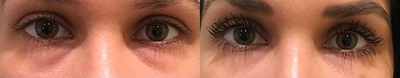 Botox - This female patient was treated with Redensity II under her eyes to help reduce the appearance of bags. Her eyes look refreshed and rejuvenated.