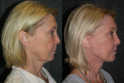 Lip Repositioning - Lip Lift + Deep Plane Facelift