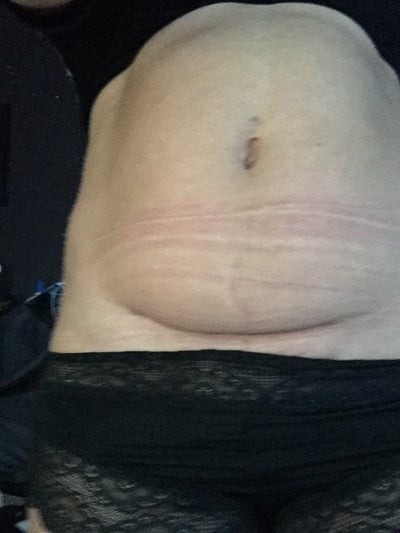 tummy tuck scars