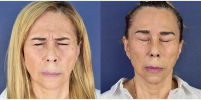 55-64 year old woman treated with Brow Lift, Canthoplasty, Facial Fat Transfer - Female patient with periorbital and forehead aging process. Dr. Valdez performed an endoscopic browlift  (minimal invasive surgery) with craneal fixation with Endotine. Forehead rejuvenation were performed with corrugator and procerus muscles released. Dr. Valdez improve her eye shape with lateral canthoplasty and facial fas grafting with micro and nonofatgrafting.