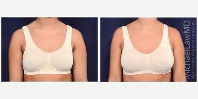 25-34 year old woman treated with Sientra Breast Implants - Breast augmentation. Follow-up photos taken 6 months after the procedure.
