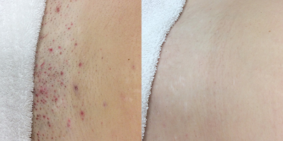 25-34 year old man treated with Laser Hair Removal - 25-34 year old man treated with Laser Hair Removal on bikini area