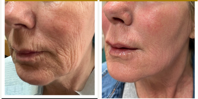 Ultherapy and fillers and laser - Three different modalities were used at the same time. We used Ultherapy to tighten the jawline and face, mixto fractional CO2 resurfacing to remove the wrinkles, and juvederm Fillers to replace lost volume. I call is Quadrafecta or a Liquid facelift. This results are three months after the procedure