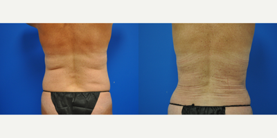 45-54 year old woman treated with Tummy Tuck, Liposuction, Breast Augmentation - This patient underwent an abdominoplasty with liposuction of the flanks and a bilateral breast augmentation