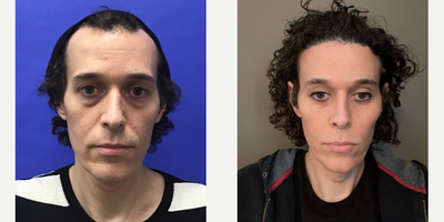 Patient treated with Cheek Augmentation, Facial Feminization Surgery, Rhinoplasty, Septoplasty, Transgender Facial Feminization  - 35-44 year-old female patient is 10 post-op from Facial Feminization surgery. Her procedures included: Placement of Tissue Expander for Flap with Hairline Forehead Lift and Orbital Bony Contour, Septorhinoplasty (closed) with Cartilage Grafts, Radix Graft and Weirs, Chin Reduction and Contour, Subnasal Lip Lift with Fascia to Lips, Cheek Implants (small), Soft Tissue to Nasolabial Folds and Lower Eyelid Blepharoplasty (TC) with Fat Reposition. Patient is 3 months post-op from: Remove Tissue Expander and Rotate Flap, Voice Feminization and Thyroid Cartilage Shave.