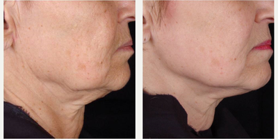 55-64 year old woman treated with TITAN - TITAN Skin Tightening improves skin laxity of the neck and jawline