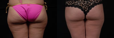 Liposuction with Body Jet - Aqualipo (Water assisted liposuction using the Body Jet), of love handles and outer thighs