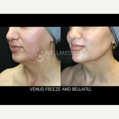 35-44 year old woman treated with Venus Freeze, Bellafill, Skin Tightening - Venus Freeze and Bellafill for the jowls
